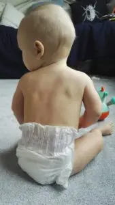 Infant Colic: What are the current recommendations?