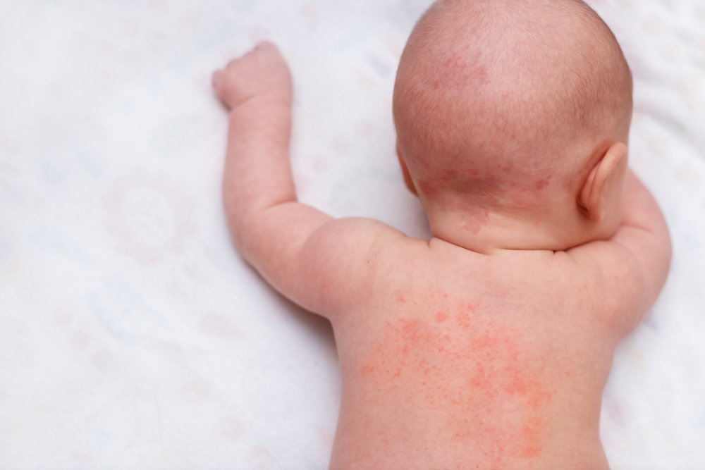 Baby with allergy to weaning